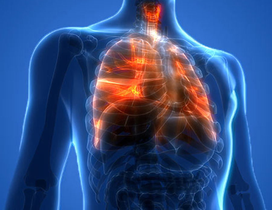 Lung injury shown in an xray